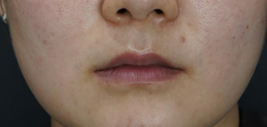 안정된 표정에서 입술선과 중앙·양옆의 볼륨을 살펴보는 정면 평가 사진