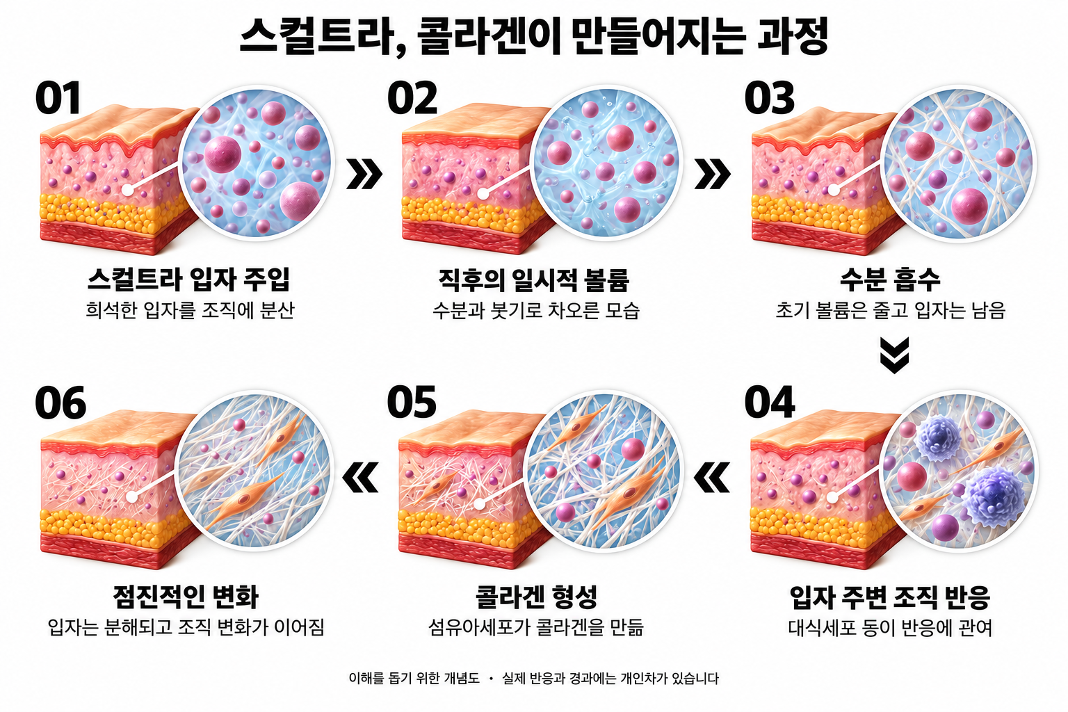 스컬트라 입자 주입, 직후의 일시적 볼륨, 수분 흡수, 입자 주변 조직 반응, 콜라겐 형성, 점진적인 변화를 흰 배경과 검정 글씨로 설명하는 6단계 개념도