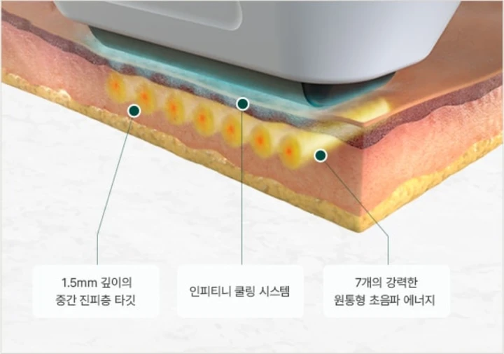 표피 냉각과 진피층의 7개 평행 초음파 열 자극을 보여주는 단면 그림