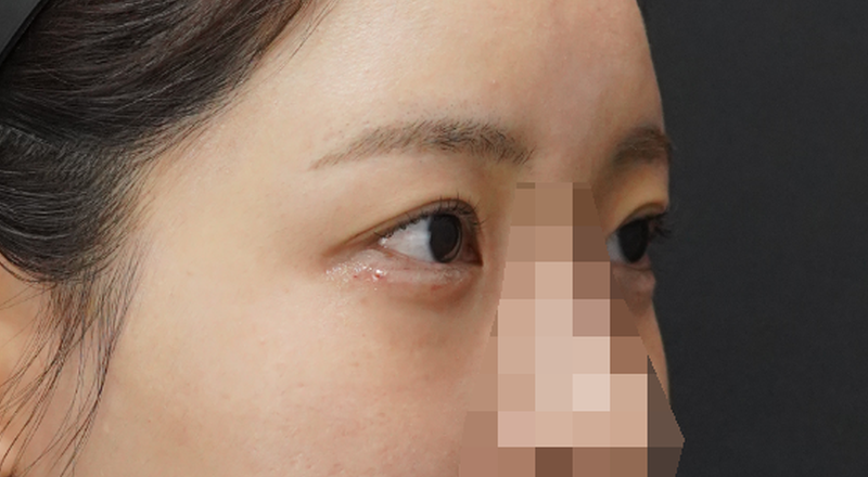 2026년 4월 레스틸렌 아이라이트 애교필러 시술 당일 후 · 사선 B, 눈과 애교 부위 중심 크롭 및 코 모자이크