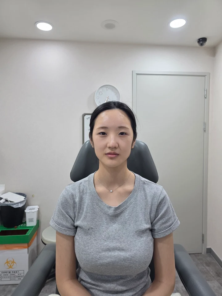 이마필러 4cc·입술필러 1cc 시술 후 정면 사진, 2026년 9월 18일