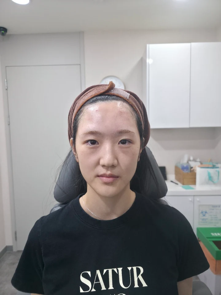 이마필러 4cc·입술필러 1cc 시술 전 정면 사진, 2026년 9월 11일