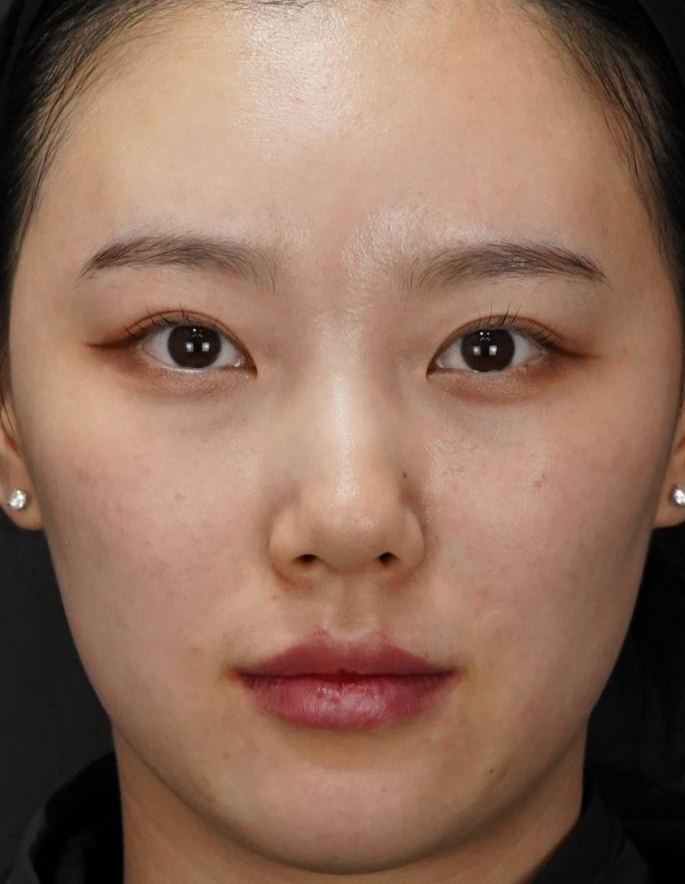 입술필러 사례 4, 정면, 입술·턱·팔자 병행 시술 직후