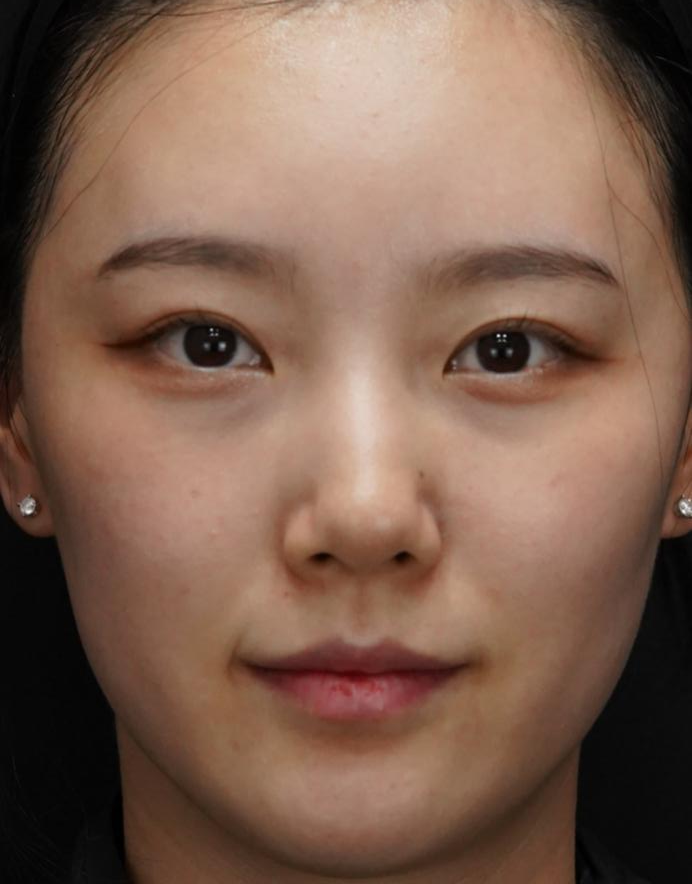 입술필러 사례 4, 정면, 시술 전