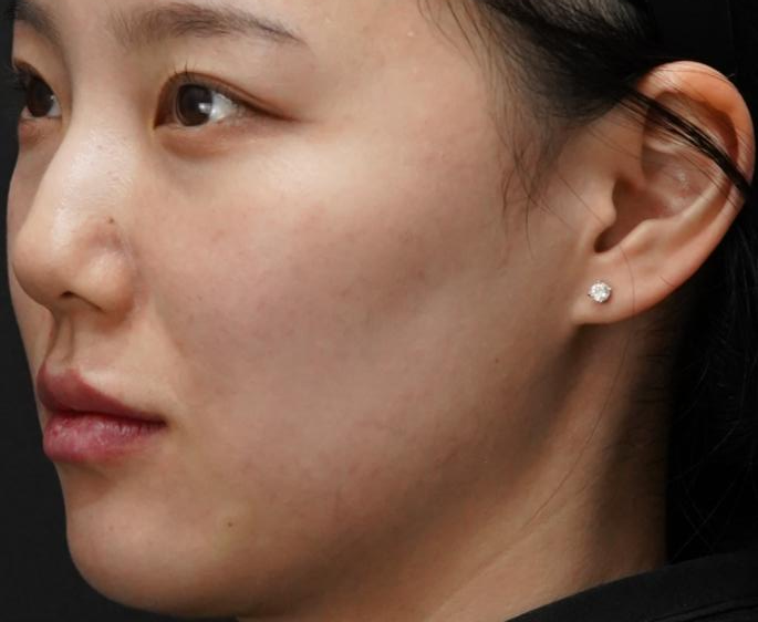 입술필러 사례 4, 사선, 입술·턱·팔자 병행 시술 직후