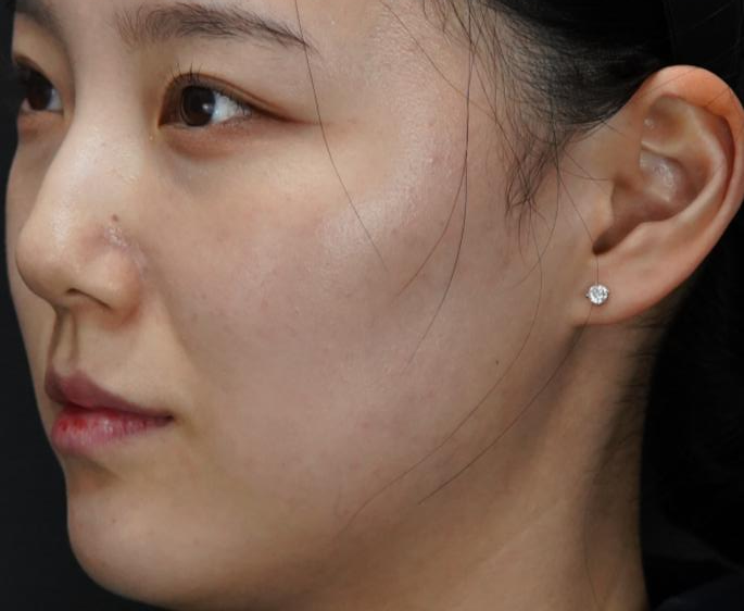 입술필러 사례 4, 사선, 시술 전