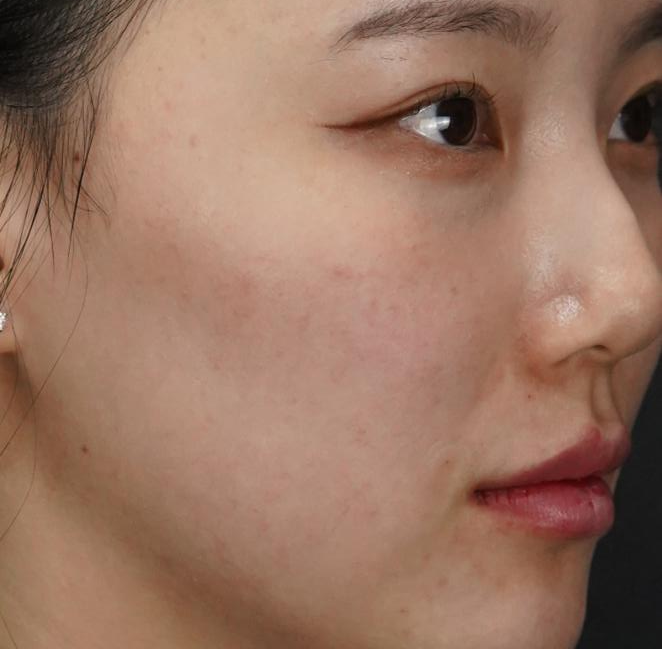 입술필러 사례 4, 화면 오른쪽 사선, 입술·턱·팔자 병행 시술 직후