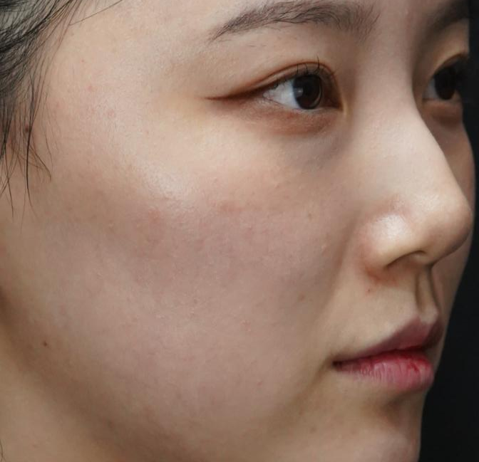 입술필러 사례 4, 화면 오른쪽 사선, 시술 전
