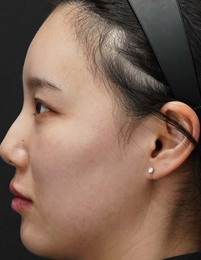 입술필러 사례 4, 화면 왼쪽 측면, 입술·턱·팔자 병행 시술 직후