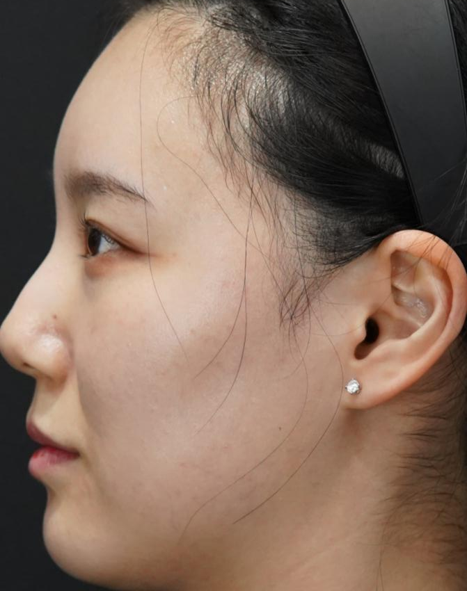 입술필러 사례 4, 화면 왼쪽 측면, 시술 전