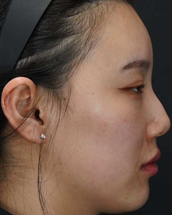 입술필러 사례 4, 화면 오른쪽 측면, 입술·턱·팔자 병행 시술 직후