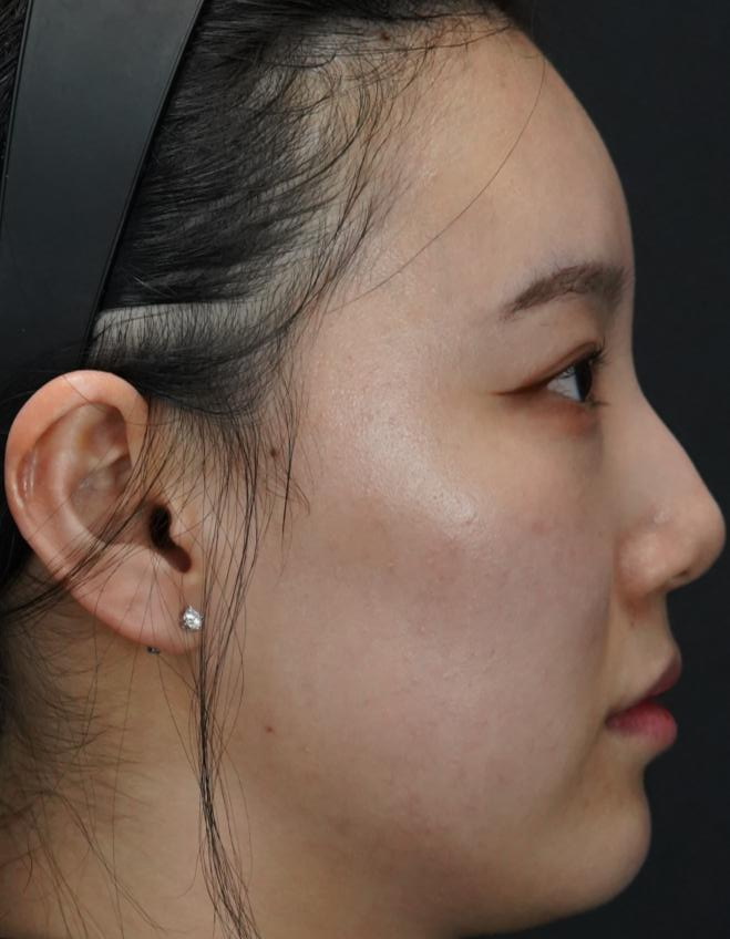입술필러 사례 4, 화면 오른쪽 측면, 시술 전