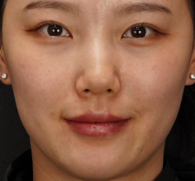 입술필러 사례 4, 웃는 표정, 입술·턱·팔자 병행 시술 직후