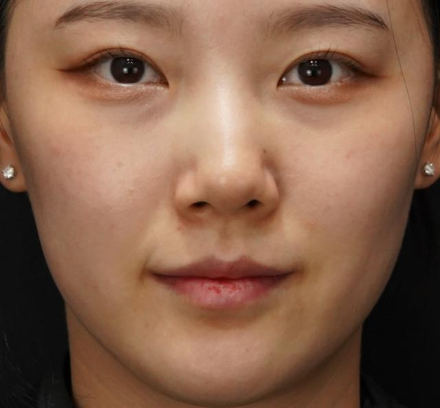 입술필러 사례 4, 웃는 표정, 시술 전