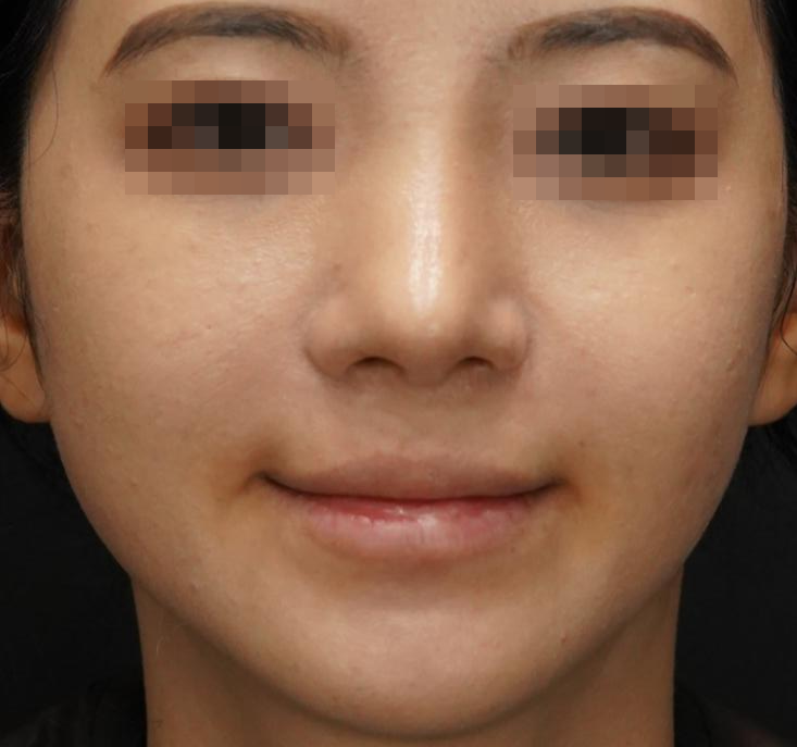 입술필러 사례 3, 정면, 시술 전