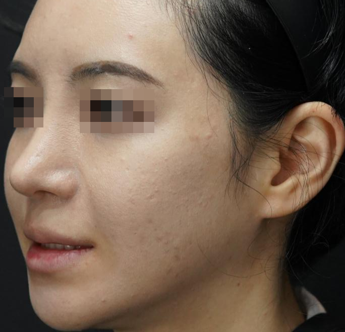 입술필러 사례 3, 사선, 시술 전