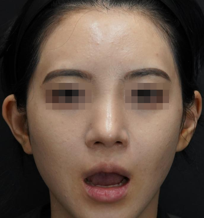 입술필러 사례 3, 입을 벌린 표정, 시술 전