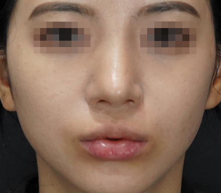 입술필러 사례 3, 입술을 오므린 표정, 시술 전