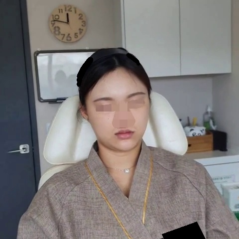 민트실 리프팅 시술 전 영상의 정면 장면, 눈과 코 모자이크