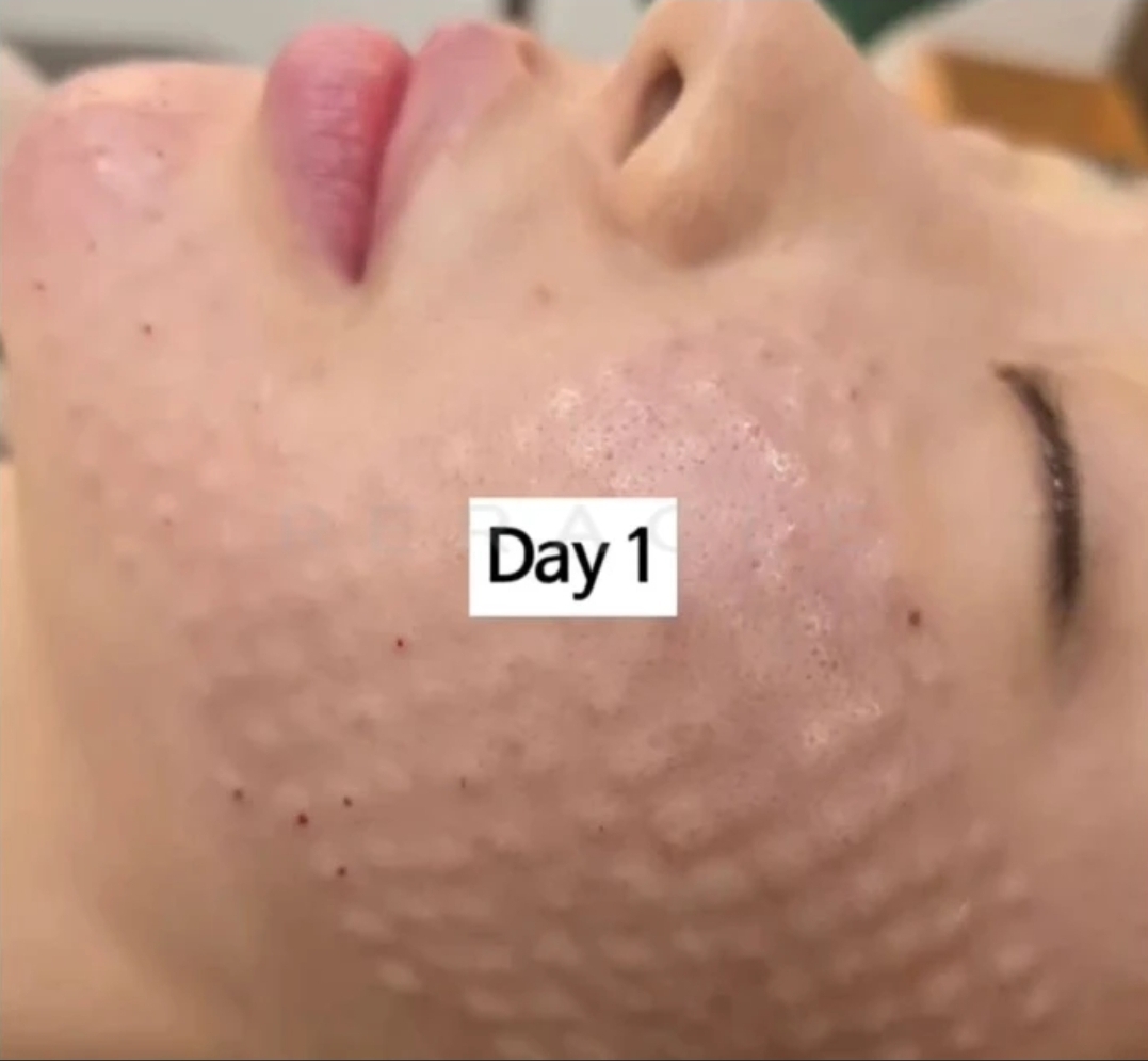 리쥬란 HB+ 4cc 시술 경과 Day 1 · 시술 당일·직후