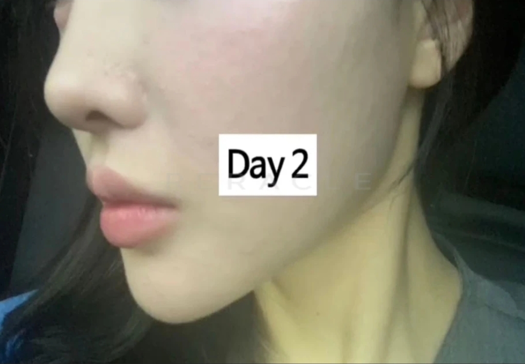리쥬란 HB+ 4cc 시술 경과 Day 2 · 시술 다음 날