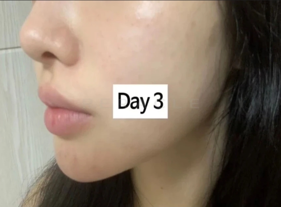 리쥬란 HB+ 4cc 시술 경과 Day 3 · 시술 2일 후