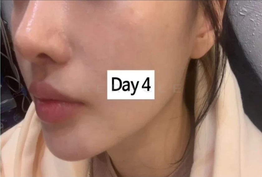 리쥬란 HB+ 4cc 시술 경과 Day 4 · 시술 3일 후