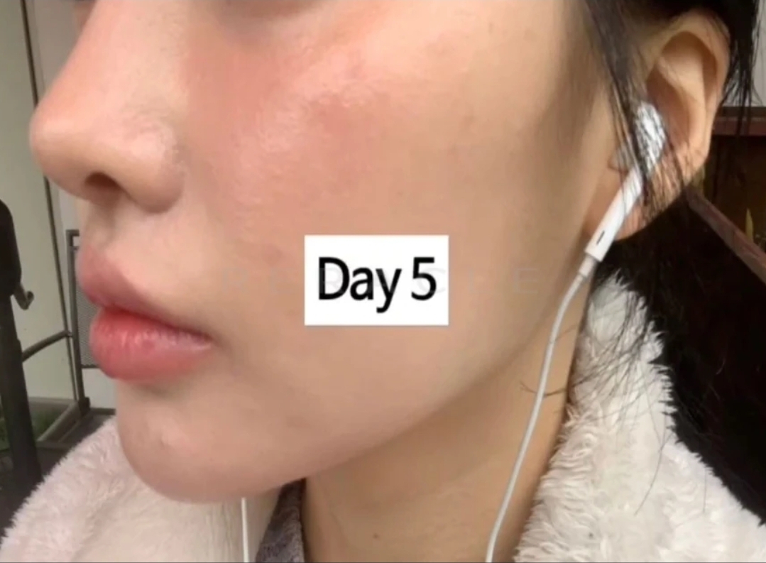 리쥬란 HB+ 4cc 시술 경과 Day 5 · 시술 4일 후
