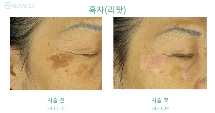 흑자(리팟) 45도 전후사진