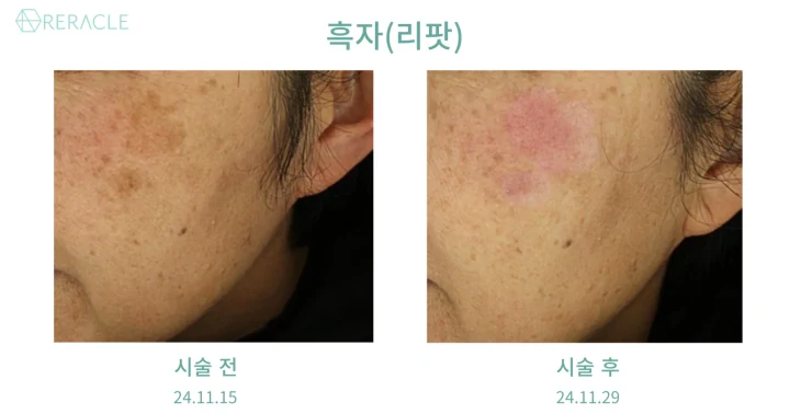 흑자(리팟) 45도 전후사진