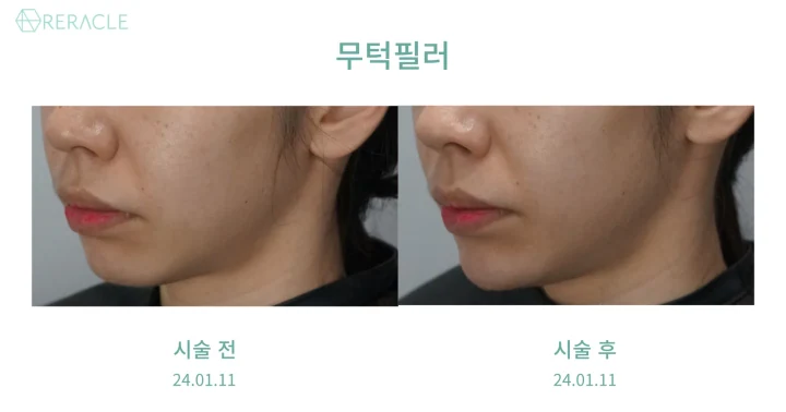 턱끝·무턱 필러 45도 전후사진
