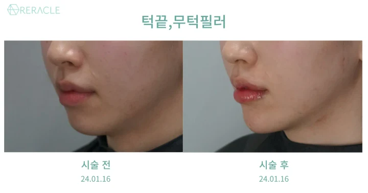 턱끝·무턱 필러 45도 전후사진