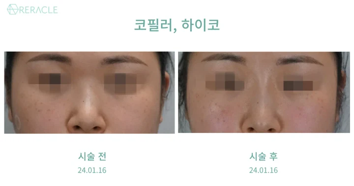 코필러·하이코 정면 전후사진