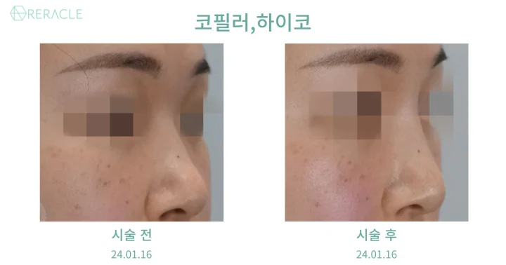코필러·하이코 45도 전후사진