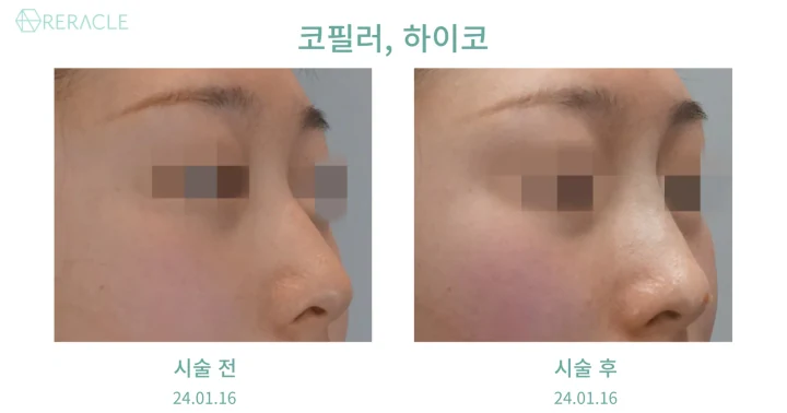 코필러·하이코 45도 전후사진