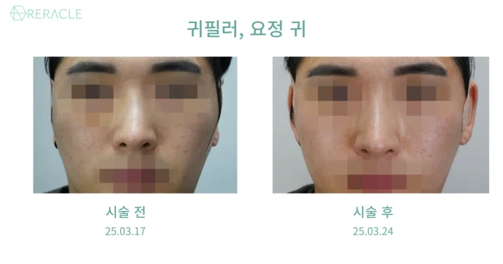 귀필러, 요정귀필러 정면 전후사진