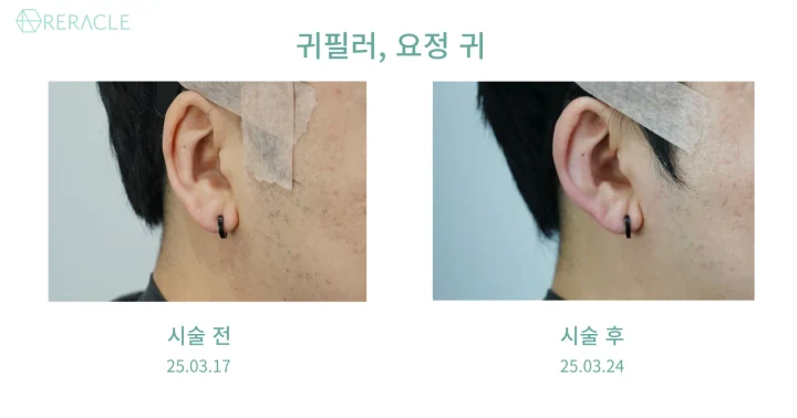 귀필러, 요정귀필러 90도 전후사진