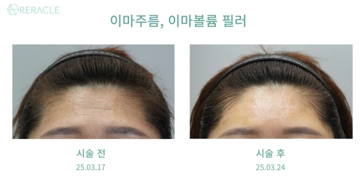 이마·관자·이마 주름 필러 정면 전후사진