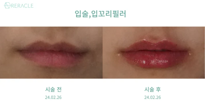입술·입꼬리 필러 정면 전후사진