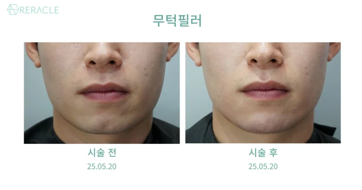 무턱필러 정면 전후사진