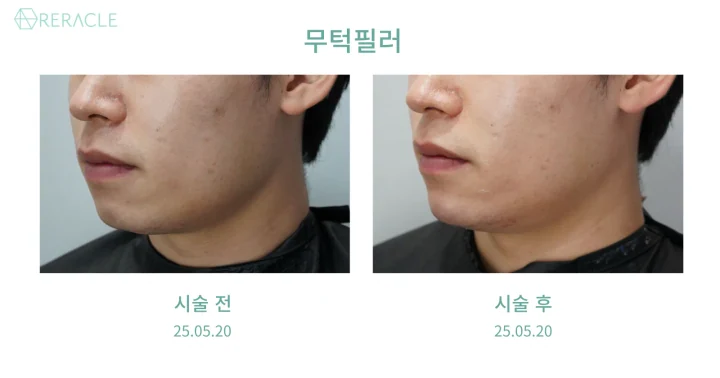 무턱필러 45도 전후사진