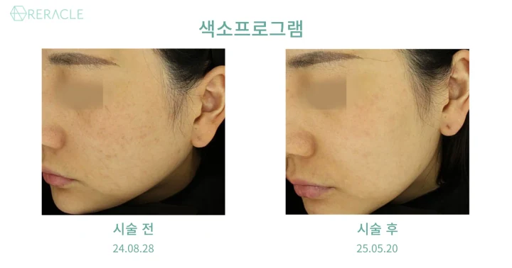 기미·잡티 45도 전후사진