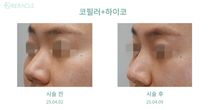 코필러 45도 전후사진