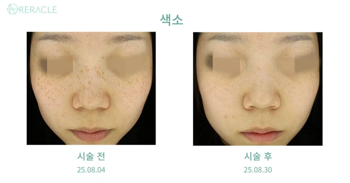 주근깨 정면 전후사진