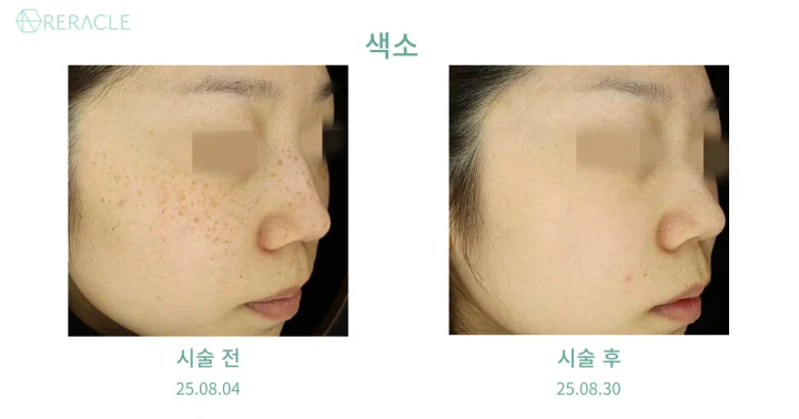 주근깨 45도 전후사진