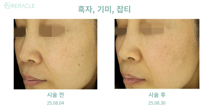 흑자 / 기미·잡티 45도 전후사진