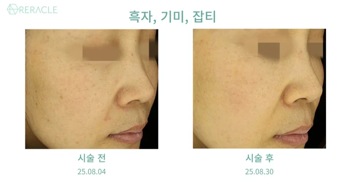 흑자 / 기미·잡티 45도 전후사진