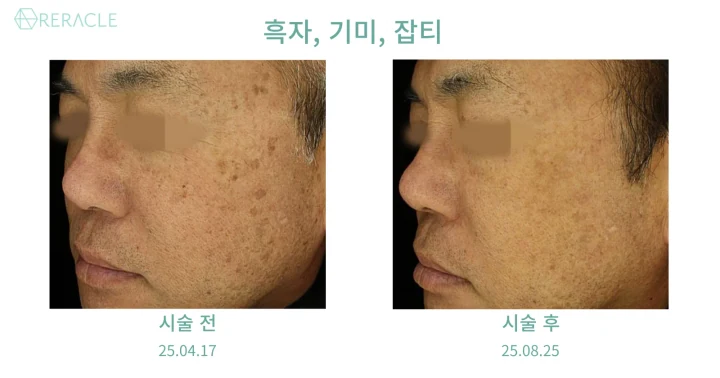 흑자 / 기미·잡티 45도 전후사진
