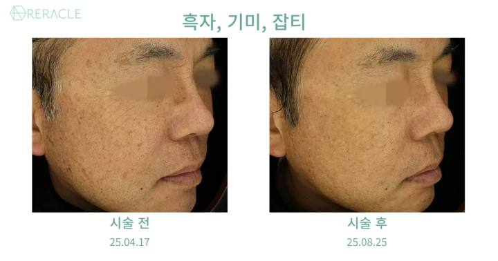 흑자 / 기미·잡티 45도 전후사진