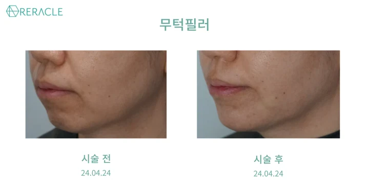 무턱필러 측면 전후사진